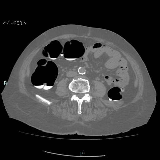 File:Colonic lipomas (Radiopaedia 49137-54244 Axial bone window 116).jpg
