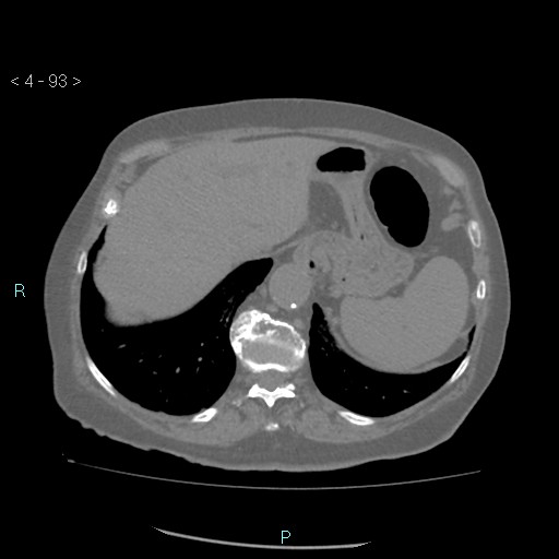 Colonic lipomas (Radiopaedia 49137-54244 Axial bone window 41).jpg