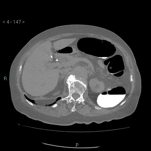 Colonic lipomas (Radiopaedia 49137-54244 Axial bone window 65).jpg