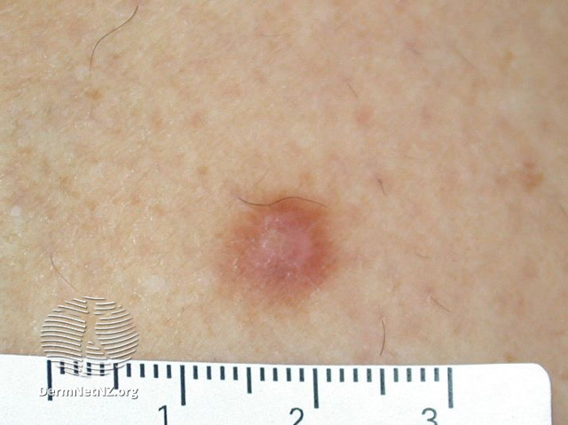 File:Dermatofibroma (DermNet NZ lesions-df5).jpg