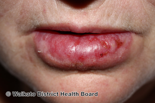 File:Discoid lupus erythematosus on lip (DermNet NZ immune-w-discoid-lupus-25).jpg
