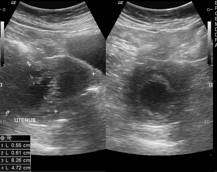 File:Endometrial thickening in tamoxifen-treated patient (Radiopaedia 10404).jpg
