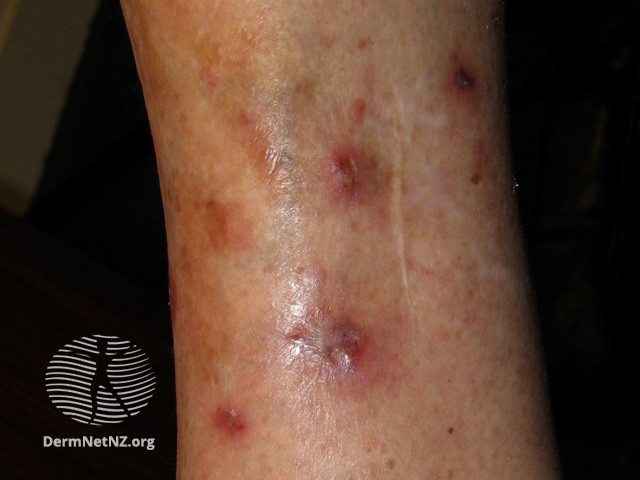 File:Intraepidermal carcinoma (DermNet NZ lesions-scc-in-situ-2967).jpg
