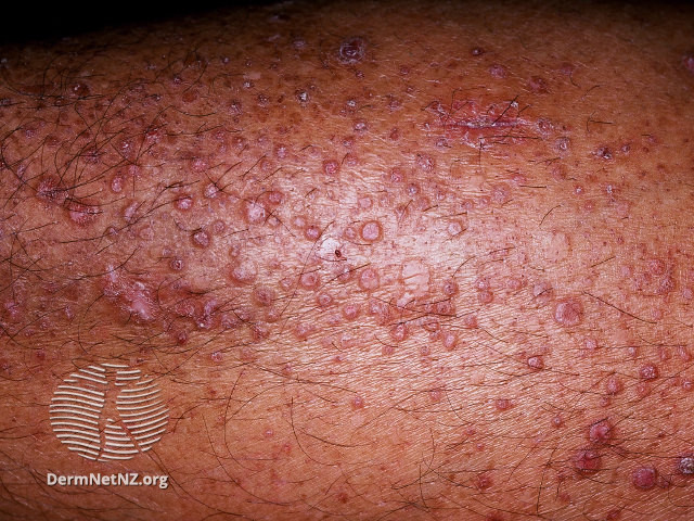 File:Lichen amyloidosis (DermNet NZ lichen-amyloidosis-22).jpg