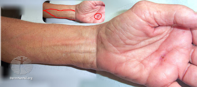 File:Lymphangitis following accidental wound. Image supplied by Dr T Evans. (DermNet NZ bacterial-lymphangitis).jpg