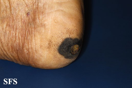 File:Melanoma (Dermatology Atlas 37).jpg