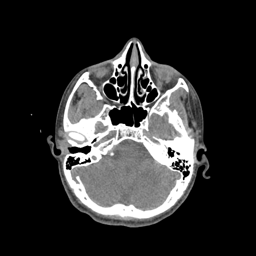 Nasal pyogenic granuloma (lobular capillary hemangioma) (Radiopaedia 85536-101244 Axial non-contrast 80).jpg