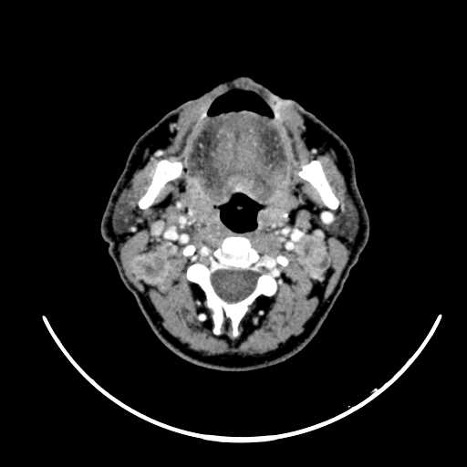 File:Nasopharyngeal carcinoma - infiltrating the clivus (Radiopaedia 62583-70875 Axial Post contrast 31).jpg