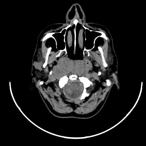 File:Nasopharyngeal carcinoma - infiltrating the clivus (Radiopaedia 62583-70875 Axial non-contrast 18).jpg
