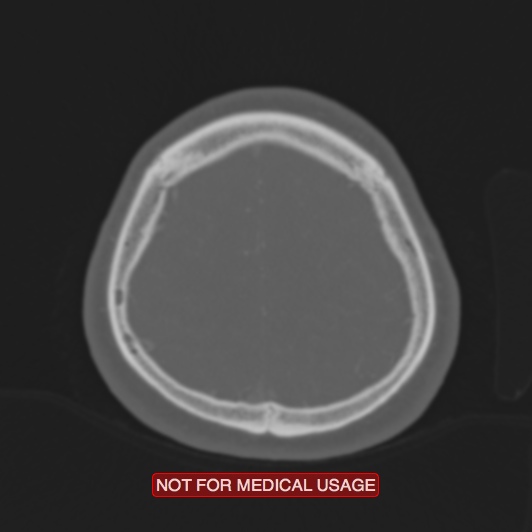 Nasopharyngeal carcinoma recurrence - skull base destruction (Radiopaedia 29107-29490 Axial bone window 20).jpg