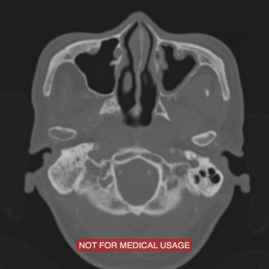 File:Nasopharyngeal carcinoma recurrence - skull base destruction (Radiopaedia 29107-29490 Axial bone window 93).jpg