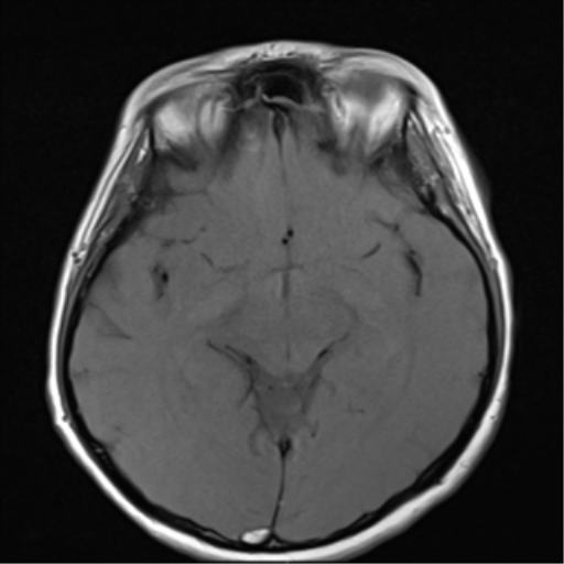 File:Nasopharyngeal carcinoma with cerebral abscess (Radiopaedia 43018-46273 Axial T1 8).png
