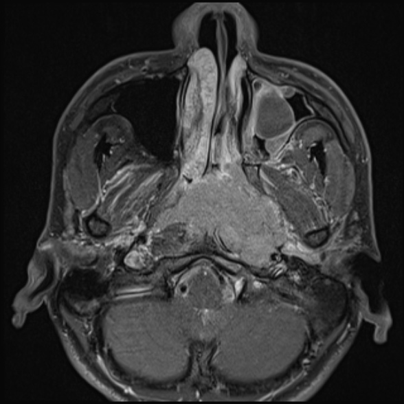 Nasopharyngeal carcinoma with skull base invasion (Radiopaedia 53415-59485 Axial T1 C+ fat sat 27).jpg