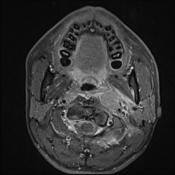 Nasopharyngeal carcinoma with skull base invasion (Radiopaedia 53415-59485 Axial T1 C+ fat sat 35).jpg