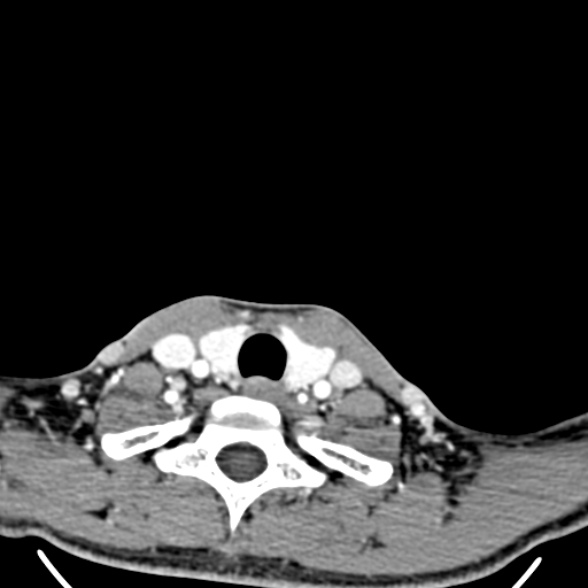 File:Nasopharyngeal carcinoma with skull base invasion (Radiopaedia 53415-59705 A 179).jpg