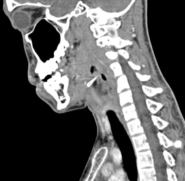 File:Nasopharyngeal carcinoma with skull base invasion (Radiopaedia 53415-59705 C 28).jpg