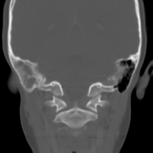 File:Nasopharyngeal rhabdomyosarcoma (Radiopaedia 23417-23491 Coronal bone window 11).jpg
