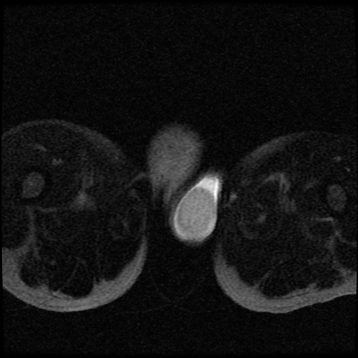 File:Necrotizing epididymo-orchitis with intra-testicular abscess (Radiopaedia 29397-29860 Axial T2 fat sat 17).jpg