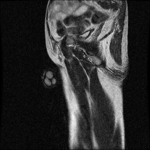 File:Necrotizing epididymo-orchitis with intra-testicular abscess (Radiopaedia 29397-29860 Sagittal T2 5).jpg