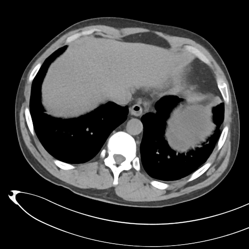 File:Necrotizing pancreatitis with acute necrotic collections (Radiopaedia 38829-41012 Axial non-contrast 11).png