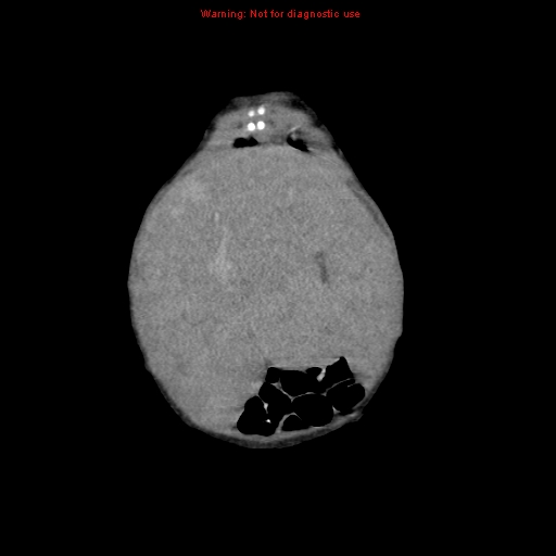 File:Neonatal neuroblastoma (Radiopaedia 9564-10223 B 24).jpg
