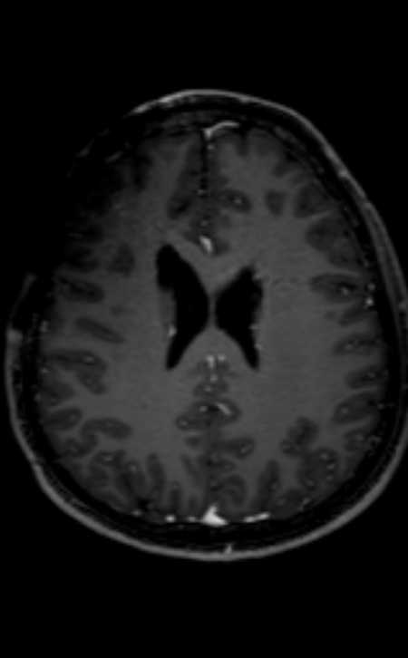 Neuro-Behçet disease (Radiopaedia 90112-107294 Axial T1 C+ 103).jpg