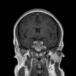 File:Neuro-Behcet's disease (Radiopaedia 21557-21505 Coronal T1 C+ 8).jpg