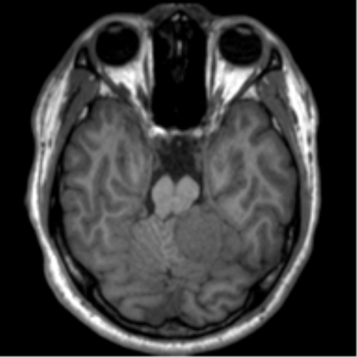 File:Neurofibromatosis type 2 (Radiopaedia 44936-48838 Axial T1 45).png