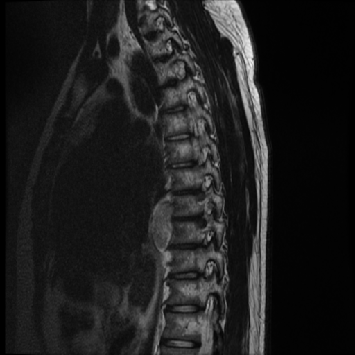 File:Neurofibromatosis type 2 (spinal manifestations) (Radiopaedia 53943-60070 C 10).png
