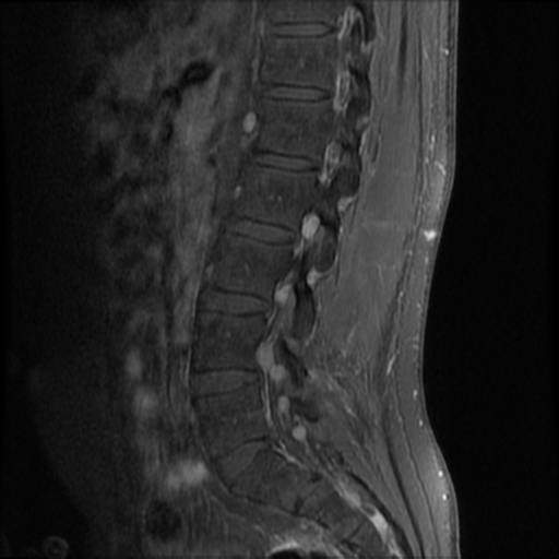 File:Neurofibromatosis type 2 (spinal manifestations) (Radiopaedia 53943-60070 K 10).png