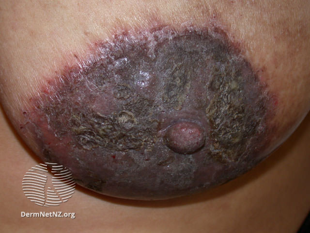 File:Nipple eczema (DermNet NZ dermatitis-atopic43).jpg