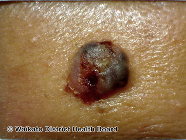File:Nodulocystic basal cell carcinoma (DermNet NZ basal-skin-of-colour-02).jpg