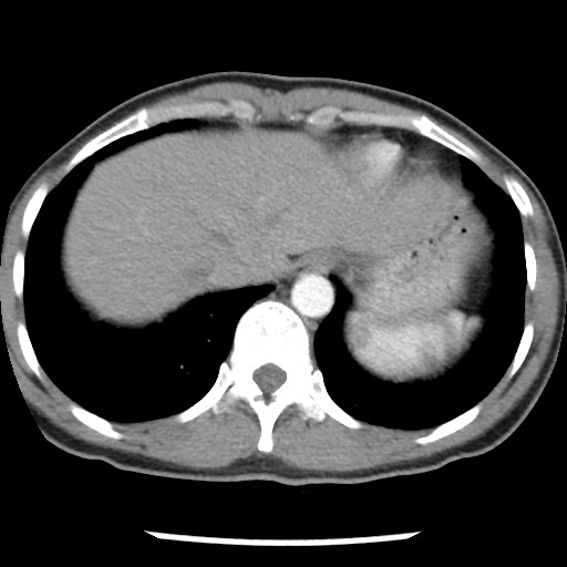 File:Non-small cell lung cancer with miliary metastases (Radiopaedia 23995-24193 A 34).jpg