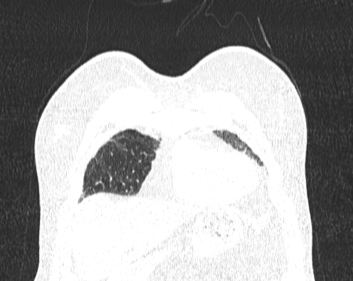 Non-specific interstitial pneumonia (NSIP) (Radiopaedia 68599-78228 Coronal lung window 7).jpg