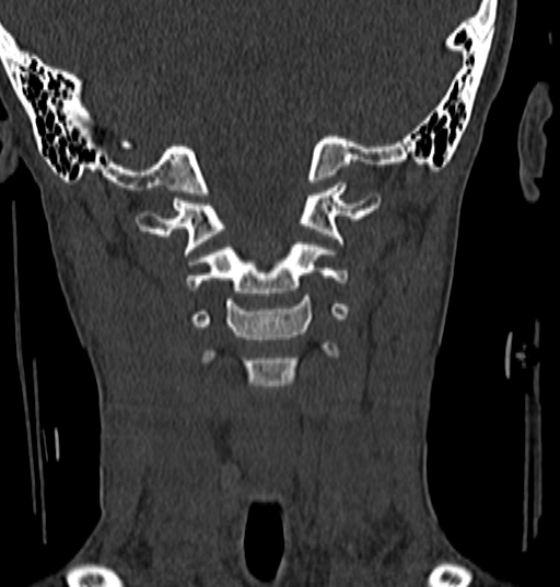 File:Normal CT cervical spine - 12-year-old (Radiopaedia 55352-61775 Coronal bone window 81).jpg
