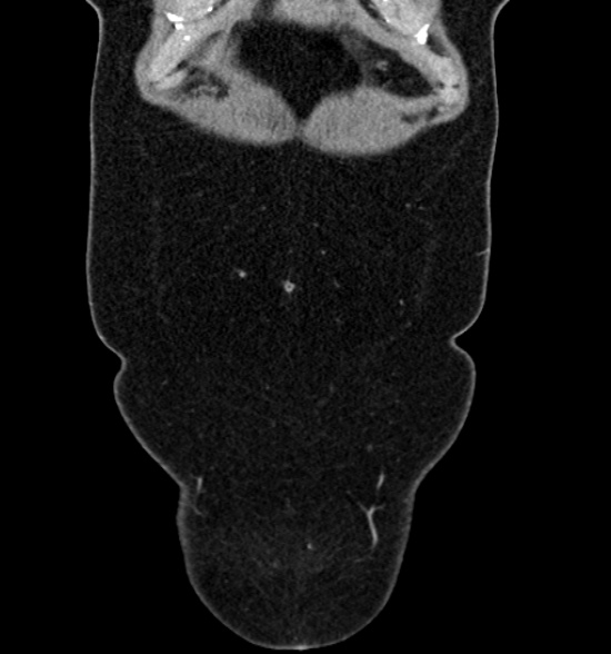 File:Normal CT intravenous urogram (Radiopaedia 39444-41759 A 159).jpg