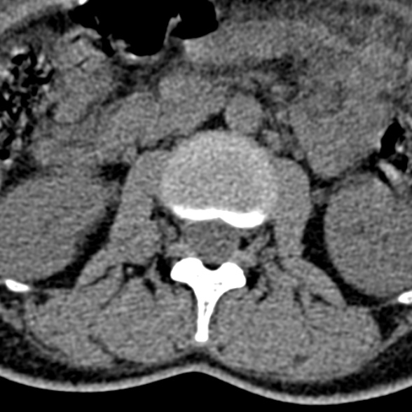 Normal CT lumbar spine (Radiopaedia 53981-60118 Axial non-contrast 38).jpg