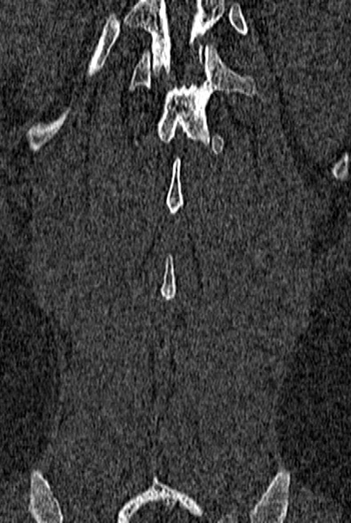 Normal CT lumbar spine (Radiopaedia 53981-60118 Coronal bone window 63).jpg
