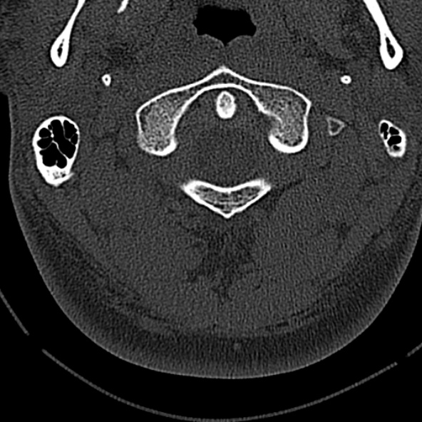 File:Normal CT of the cervical spine (Radiopaedia 53322-59305 Axial bone window 53).jpg