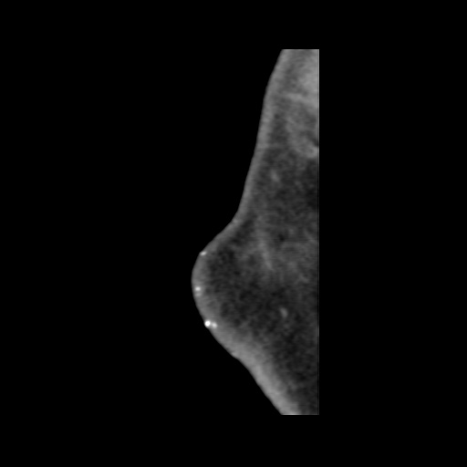 Normal CT paranasal sinuses (Radiopaedia 42286-45390 F 143).jpg
