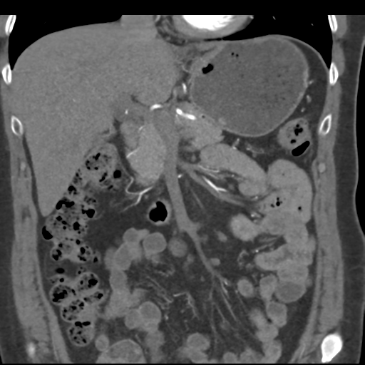 File:Normal CT renal artery angiogram (Radiopaedia 38727-40889 B 31).png