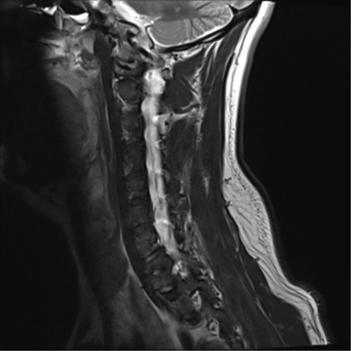 File:Normal MRI cervical spine (infection protocol) (Radiopaedia 53916-60039 Sagittal T2 5).png