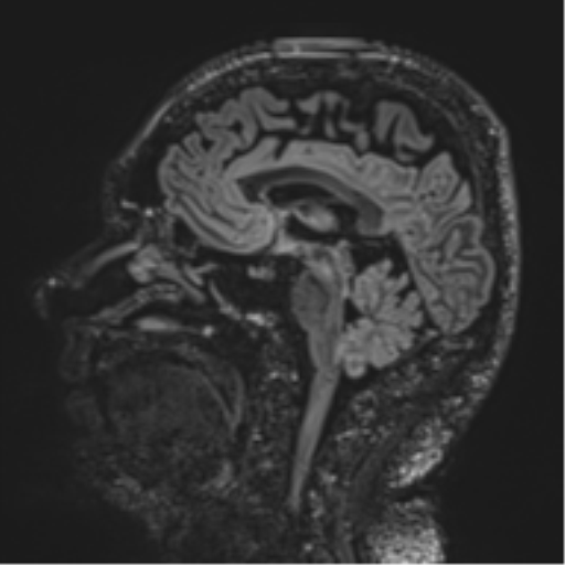 Normal brain MRI (non-focal epilepsy protocol) (Radiopaedia 53917-60040 Sagittal DIR 34).png