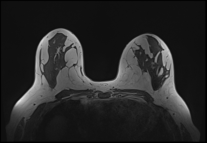 File:Normal breast MRI - dense breasts (Radiopaedia 80454-93850 Axial T1 111).jpg