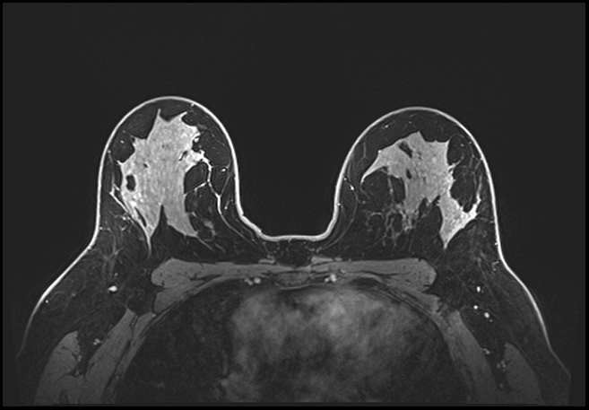 Normal breast MRI - dense breasts (Radiopaedia 80454-93850 C 138).jpg