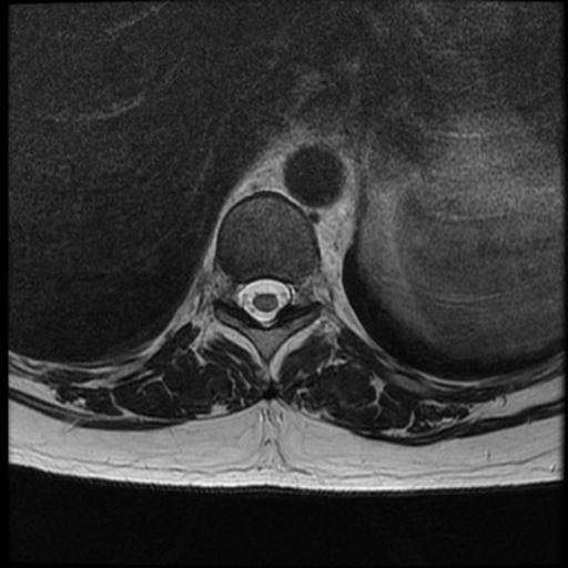 File:Normal cervical and thoracic spine MRI (Radiopaedia 35630-37156 H 14).png