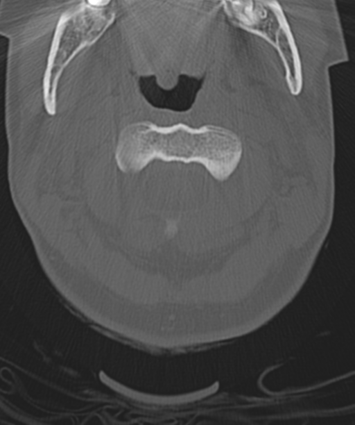 Normal cervical spine MRI (including Dixon) (Radiopaedia 42762-45926 Axial bone window 15).png