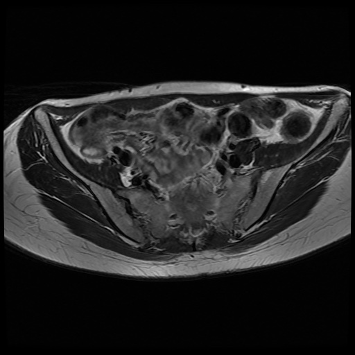 File:Normal female pelvis MRI (retroverted uterus) (Radiopaedia 61832-69933 Axial T2 10).jpg