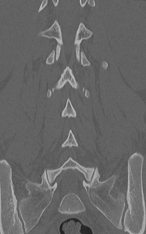 Normal lumbar spine CT (Radiopaedia 46533-50986 Coronal bone window 51).png