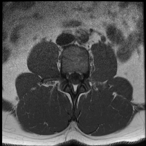 File:Normal lumbar spine MRI (Radiopaedia 35543-37039 Axial T1 25).png